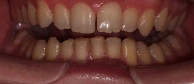 Ортодонтическое лечение на элайнерах №5