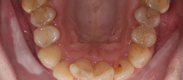 Лечение на Invisalign