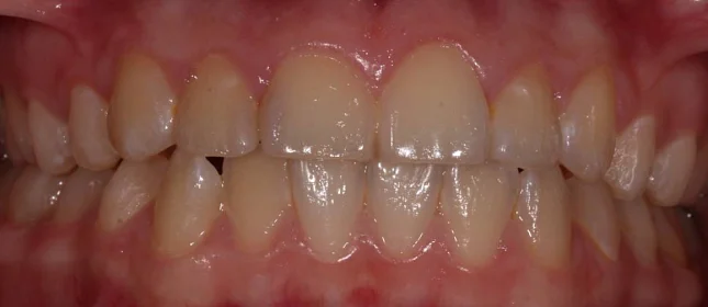 Ортодонтическое лечение на брекет-системе №3