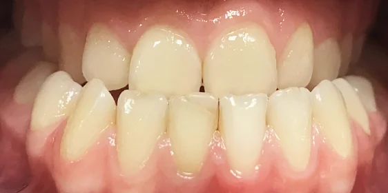 Исправление мезиального прикуса с помощью элайнеров Invisalign и минивинтов