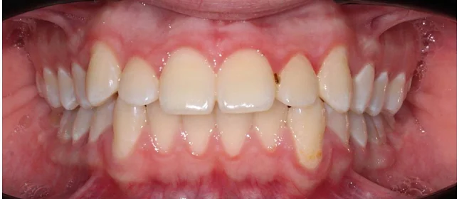 Ортодонтическое лечение на системе Click №4