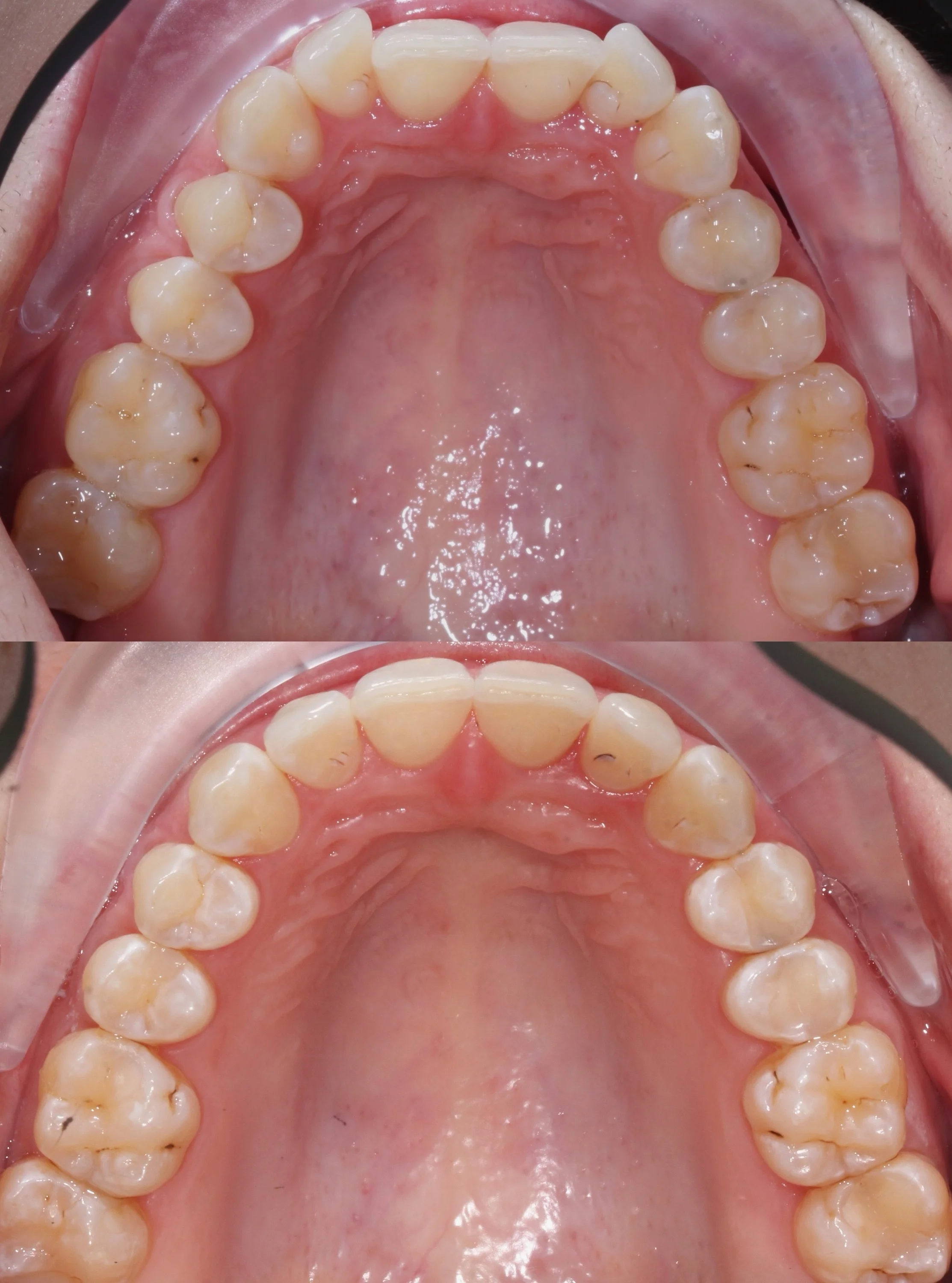 Изменение скученности зубов с помощью системы Invisalign