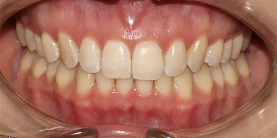 Ортодонтическое лечение на элайнерах