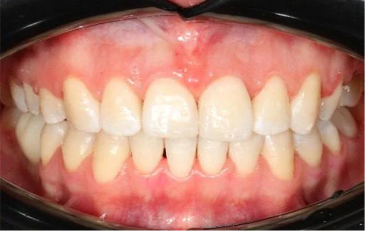 Ортодонтическое лечение на брекет-системе