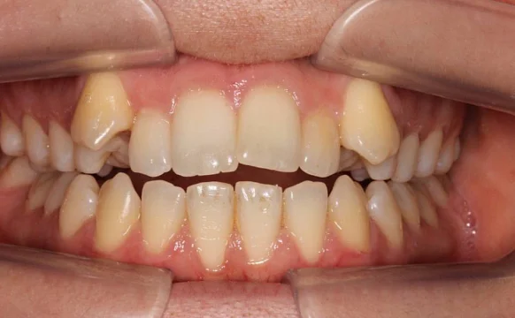 Корреция открытого прикуса элайнерами