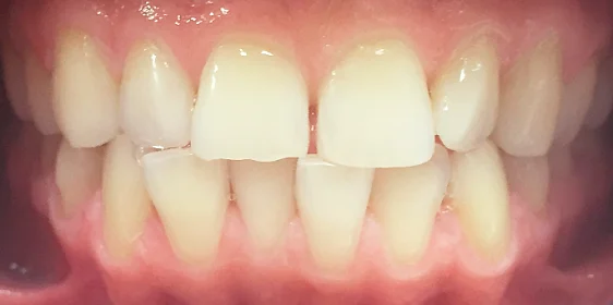 Исправление прикуса элайнерами Инвизилайн