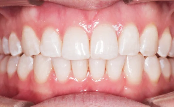 Исправление прикуса. 29 кап, 14 месяцев лечения