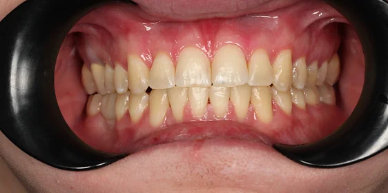 Лечение аномалии соотношений зубных дуг на брекет-системе