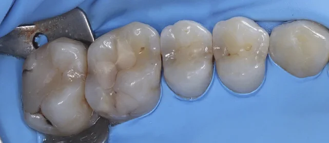 Лечение кариеса