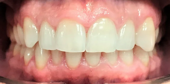 Исправление прикуса. 27 кап, 14 месяцев лечения