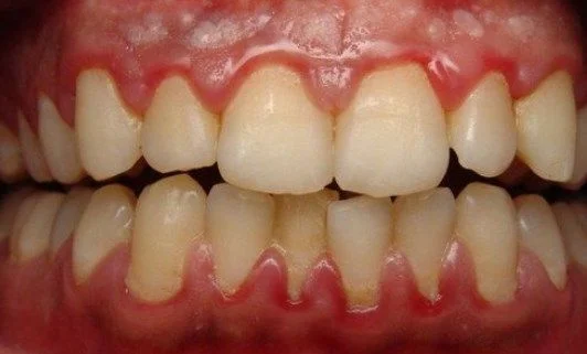 симптомы гингивита фото