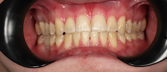 Лечение аномалии соотношений зубных дуг на брекет-системе