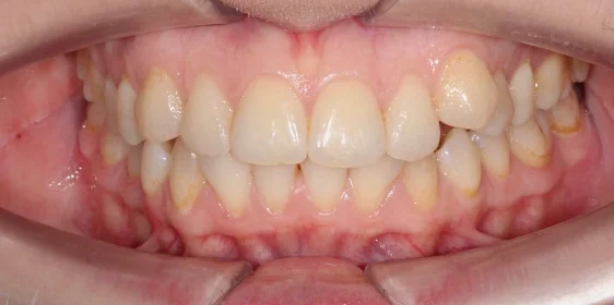 Лечение скученности зубов элайнерами