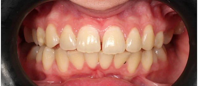 Ортодонтическое лечение на системе Click №5