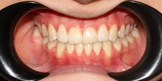 Ортодонтическое лечение на элайнерах