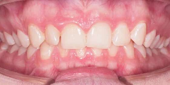 Исправление прикуса. 29 кап, 7 месяцев лечения