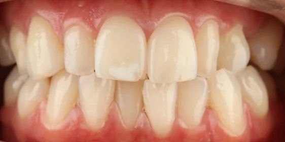 Коррекция аномалии положения зубов на элайнерах