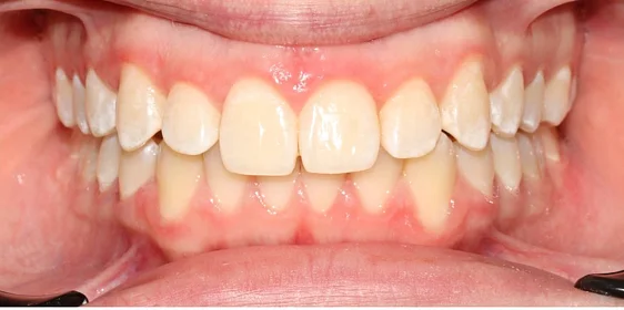 Ортодонтическое лечение на системе Click