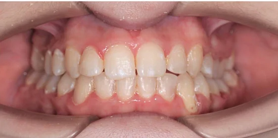 Ортодонтическое лечение на элайнерах