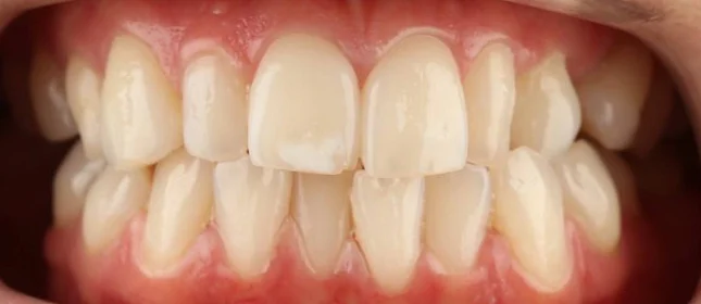 Коррекция аномалии положения зубов на элайнерах