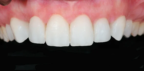 Восстановление эстетики винирами