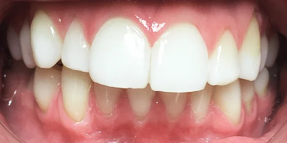 Лечение дистального прикуса с последующим ретенционным периодом