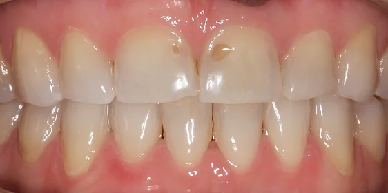 Нормализация смыкания и устранение скученности