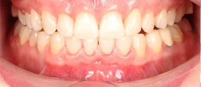 Коррекция дистальной окклюзия на брекет-системе