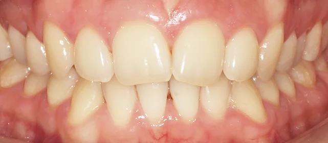 Устранение глубокого перекрытия с помощью элайнеров