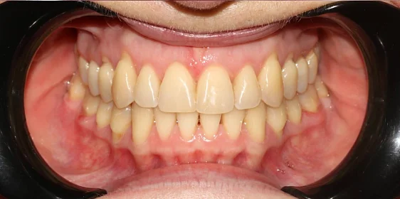 Ортодонтическое лечение на элайнерах