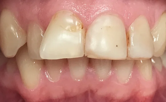 Подготовка зубных рядов к последующей установке виниров