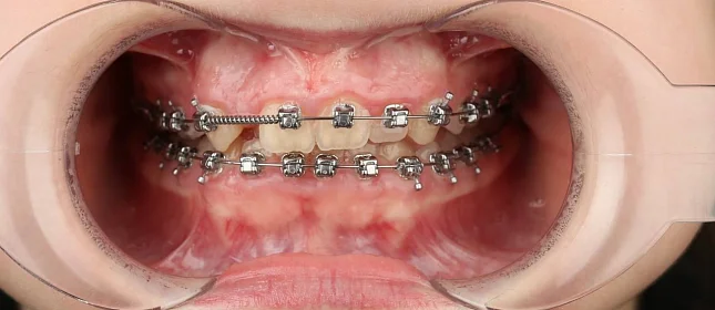 Лечение скученности зубов на брекет-системе