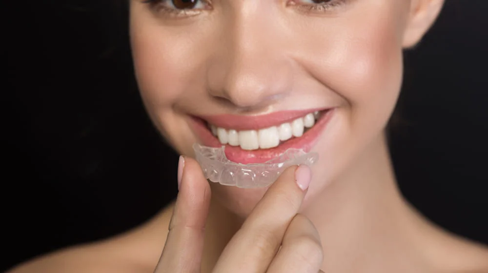 современные брекеты