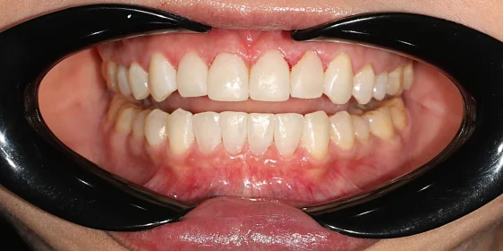 Ортодонтическое лечение на элайнерах