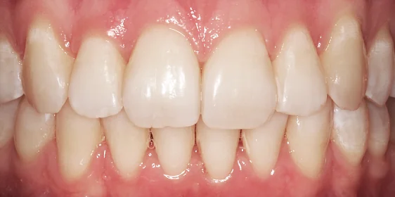 Исправление фронтальной группы зубов капами Инвизилайн