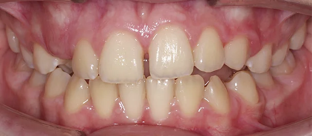 Исправление вертикальной-резцовой дизокклюзии у подростка