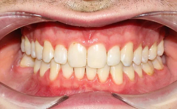 Ортодонтическое лечение на системе Click