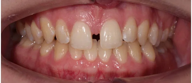 Ортодонтическое лечение на элайнерах №8