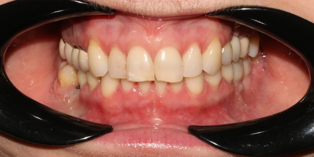 Лечение скученности зубов на брекет-системе