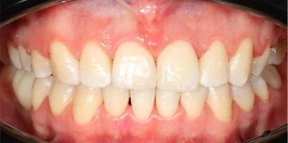 Ортодонтическое лечение на брекет-системе