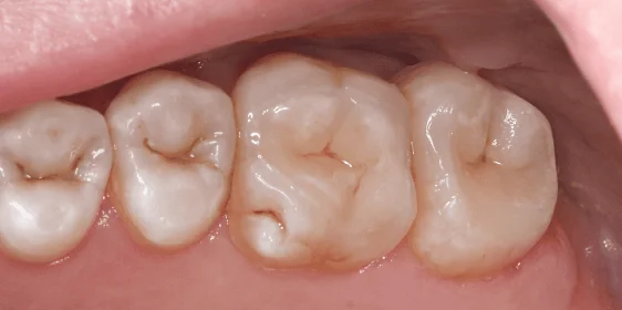 Восстановление эстетики с помощью виниров и вкладок (часть 2)