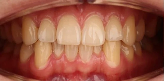 Ортодонтическое лечение на элайнерах