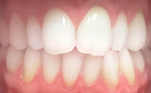 Выравнивание зубных рядов элайнерами Invisalign