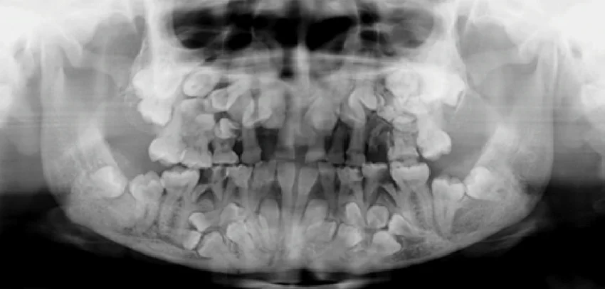 аномалии количества зубов фото