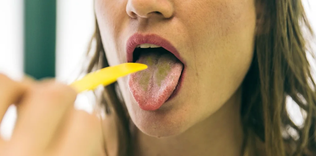 налет на языке фото