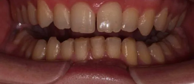 Ортодонтическое лечение на элайнерах №5
