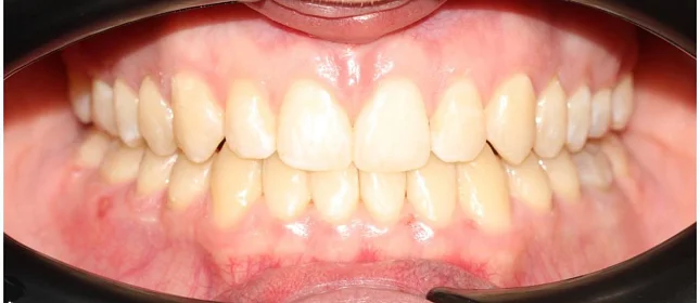 Ортодонтическое лечение на элайнерах №8