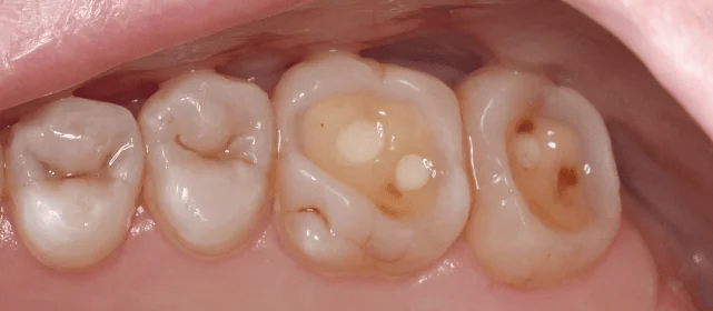 Восстановление эстетики с помощью виниров и вкладок (часть 2)