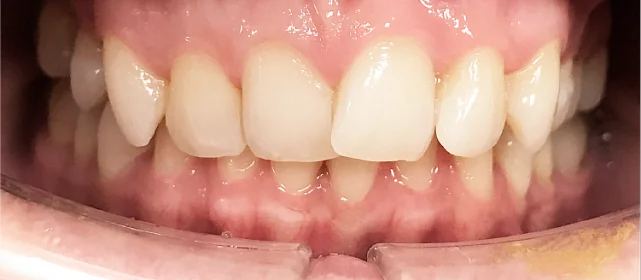 Исправление глубокого перекрытия зубов без брекетов