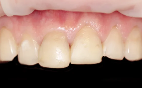 Протезирование зубов верхней челюсти винирами